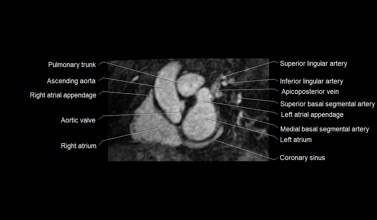 MRI heart and coronary arteries short axis anatomy image 14.webp